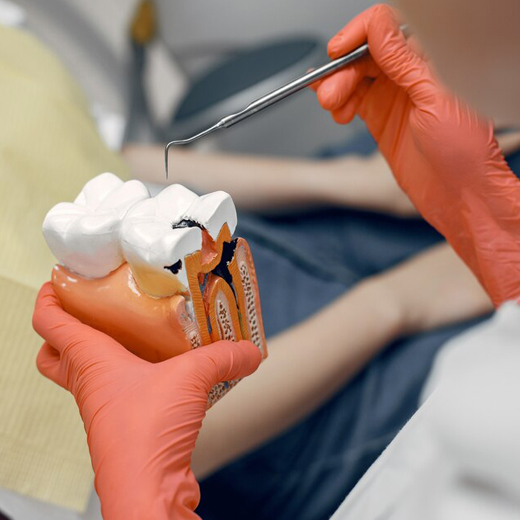 Root Canal Treatment